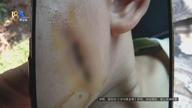 厥筋都断了……街头常见看见立即远离！凯发K8旗舰厅后怕！5岁男童瞬间晕(图4)