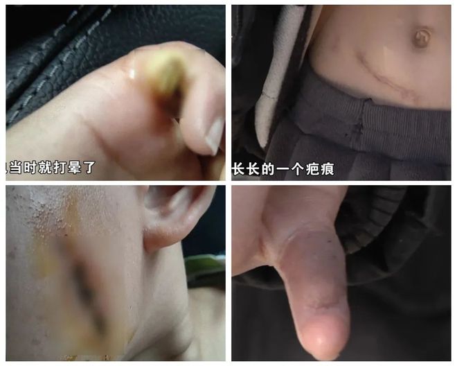 ！5岁儿童爬空调外机瞬间晕厥！凯发k8娱乐登录肌腱都打断了